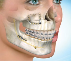 Chirurgia_maxillo_facciale